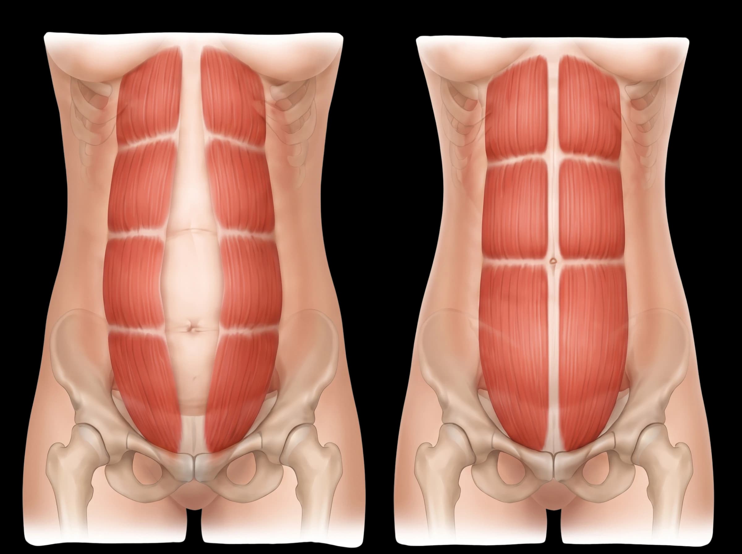 Medical illustration comparing abdominal muscles separated by diastasis recti with normal abdominal muscles